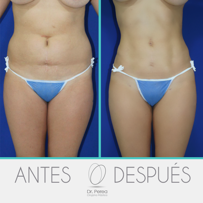 Liposucción
